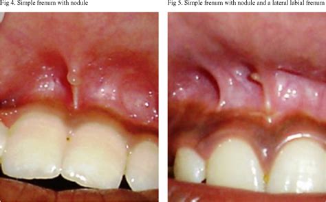 frenulum plural